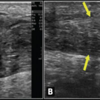 Figure 1: Ultrasound images of the right Achilles tendon: (a) pre-operative image demonstrating complete tendon rupture with loss of continuity and hypoechoic gap (yellow arrows indicate the rupture margins); (b) 3-year follow-up demonstrating restored tendon continuity with no evidence of re-rupture (yellow arrows delineate the intact repaired tendon).