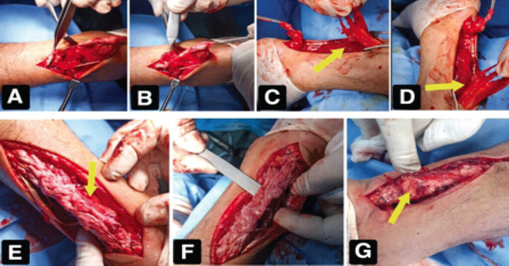 Figure 2: Intraoperative sequence: (a and b) complete rupture with severely frayed “mop-end” tendon ends; (c and d) macerated and poorly defined rupture margins; (e and f) Krackow locking-loop repair with circumferential polypropylene suture reinforcement and overlying preserved viable local soft-tissue sutured over the repaired tendon as a biological onlay augmentation layer; (g) layered wound closure. Yellow arrows indicate the viable local soft tissue (biological onlay augmentation layer): (c and d) the tissue identified in situ between the repaired tendon and the posterior tibial surface before mobilization; (e and g) the repair site following biological augmentation with the preserved viable local soft tissue.