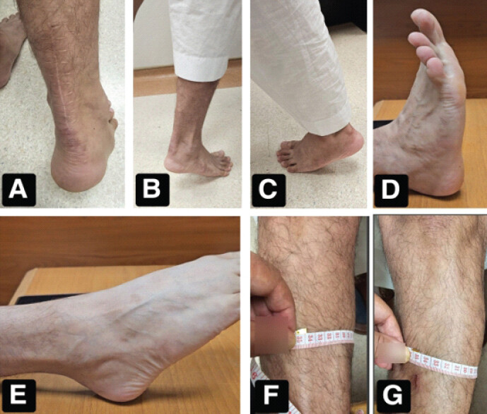 Figure 3: Clinical outcomes at 3-year follow-up: (a) well-healed surgical scar; (b and c) single-leg heel-rise on the operated and contralateral limbs; (d and e) full active ankle dorsiflexion and plantar flexion; (f and g) bilateral calf circumference measurements confirming no clinically significant asymmetry.