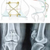 Combined Cerclage and Figure-of-eight Tension-band Wiring without K-wire Versus K-wire Tension Band Wiring Fixation for Transverse Patellar Fractures: A Prospective Comparative Study