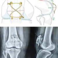 Figure 1: Technique of Kirschner wire tension band wiring and radiographs.