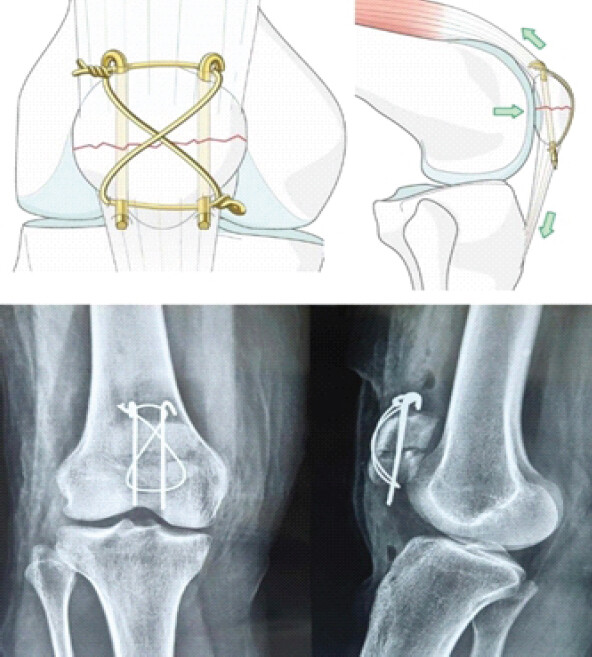 Figure 1: Technique of Kirschner wire tension band wiring and radiographs.