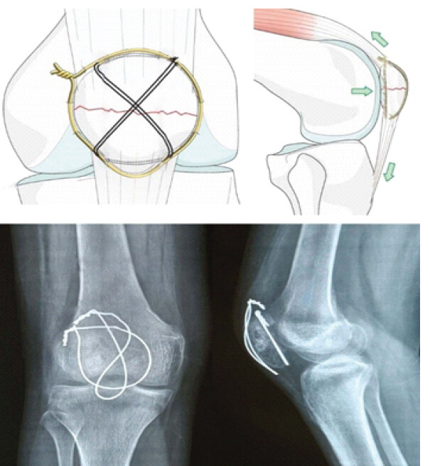 Figure 2: Technique of combined cerclage tension band wiring without Kirschner wires and radiographs.