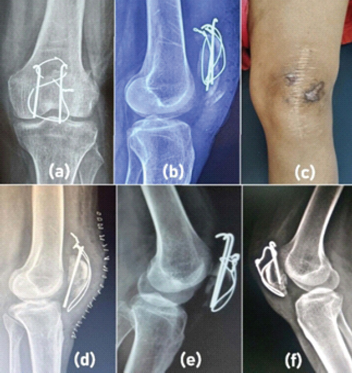 Figure 4: Complications like implant breakage, (a) Implant displacement and loss of reduction, (b) Skin complications, (c) Kirschner wire slippage and proximal migration (d, e, f).
