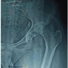 Complex Reconstruction of Post-traumatic Fracture Dislocation Hip: The Anchor Total Hip Arthroplasty Following Failed Index Surgery