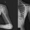 Hybrid Prosthetic and Biological Reconstruction Using Extracorporeal Radiotherapy for Long-Segment Humeral Osteosarcoma: A Case Report