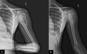 Figure 1: Pre-operative anteroposterior (a) and lateral (b) radiographs of the left arm demonstrating a mixed expansile lytic-sclerotic lesion in the proximal epimetaphysis of the humerus, accompanied by extraosseous soft tissue extension and periosteal elevation.