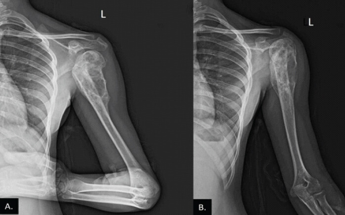 Figure 1: Pre-operative anteroposterior (a) and lateral (b) radiographs of the left arm demonstrating a mixed expansile lytic-sclerotic lesion in the proximal epimetaphysis of the humerus, accompanied by extraosseous soft tissue extension and periosteal elevation.