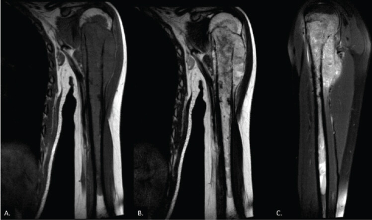 Figure 2: Pre-operative anteroposterior (a) and lateral (b) radiographs of the left arm demonstrating a mixed expansile lytic-sclerotic lesion in the proximal epimetaphysis of the humerus, accompanied by extraosseous soft-tissue extension and periosteal elevation.