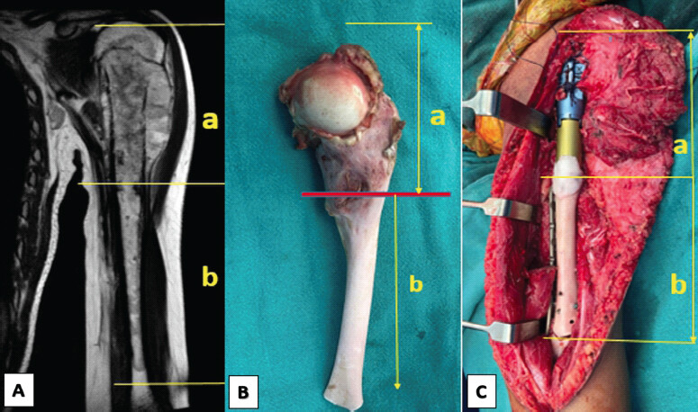 Figure 3: Intraoperative photographs detailing the hybrid reconstruction technique. The en bloc resected proximal humerus specimen is measured to determine the precise length for the intercalary graft (a and b). Following extracorporeal radiotherapy, the devitalized autograft is reimplanted and secured using a custom proximal endoprosthesis cemented into the graft, augmented with a locking compression plate fixed to the preserved distal humerus (c).