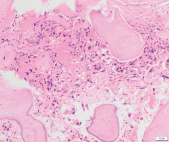 Figure 4: Histopathological examination (×40) of the resected specimen showing scant residual malignant mesenchymal cells with hyperchromatic nuclei and moderate cytoplasm within the intertrabecular spaces. The field demonstrates extensive hyalinization, fibrosis, and lacy osteoid deposition, consistent with a poorly differentiated, high-grade conventional osteosarcoma (ypT1).