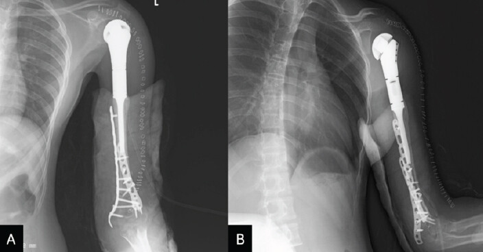 Figure 5: Post-operative anteroposterior (a) and lateral (b) radiographs confirming the anatomical alignment and stable fixation of the hybrid composite reconstruction, showing the proximal humeral endoprosthesis and the lateral locking plate securing the irradiated autograft to the distal humerus.