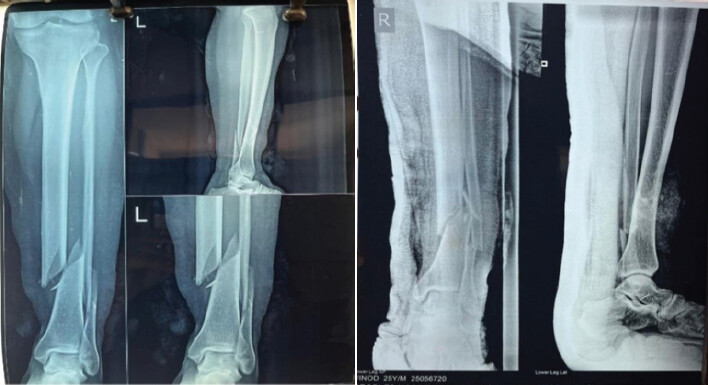 Figure 4: Pre-operative X-rays of the patients.
