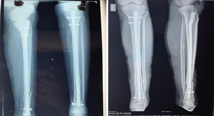 Figure 5: Post-operative X-rays of the patients.