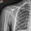 First Rib Stress Fracture Masquerading as Periscapular Muscle Strain in a 10-Year-Old Softball Player