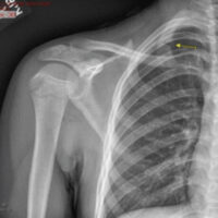 Figure 1: Initial right shoulder radiograph demonstrating a non-displaced first rib fracture, indicated by the arrow, that was not identified at the initial evaluation.