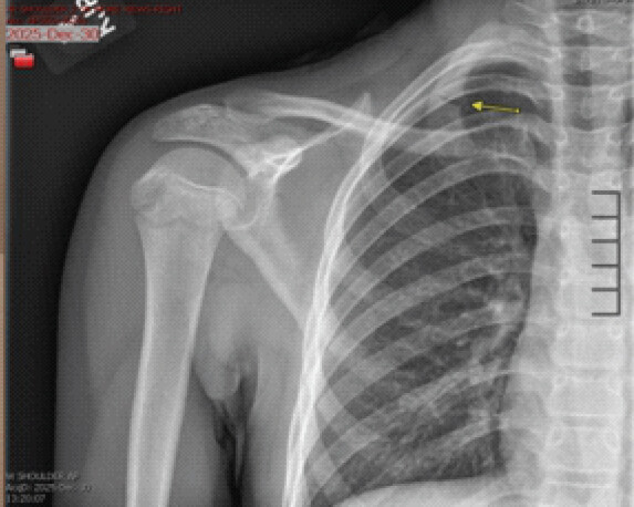 Figure 1: Initial right shoulder radiograph demonstrating a non-displaced first rib fracture, indicated by the arrow, that was not identified at the initial evaluation.