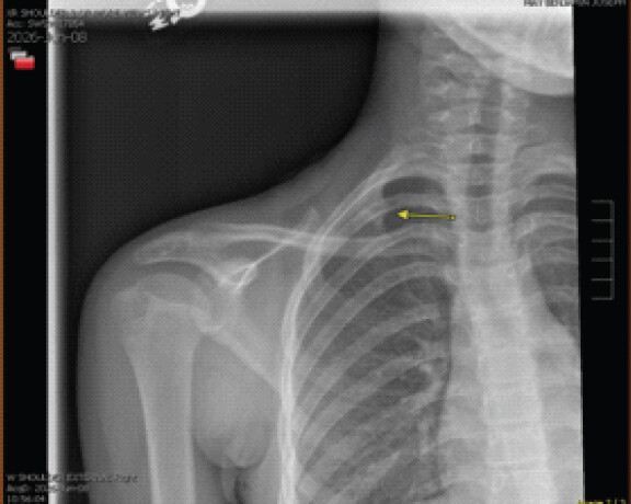 Figure 2: Follow-up right shoulder radiograph demonstrating complete healing of the right first rib fracture, with the previously seen fracture lucency no longer visible.