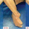 Limb Salvage of a Flail Neuropathic Ankle in Congenital Insensitivity to Pain with Anhidrosis Using a Hindfoot Superconstruct