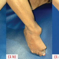 Figure 1: Clinical image of the patient’s foot: Plantar (a), Dorsum (b), and Lateral (c) surfaces of the right foot.