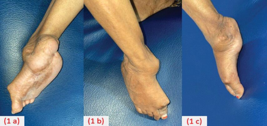 Figure 1: Clinical image of the patient’s foot: Plantar (a), Dorsum (b), and Lateral (c) surfaces of the right foot.