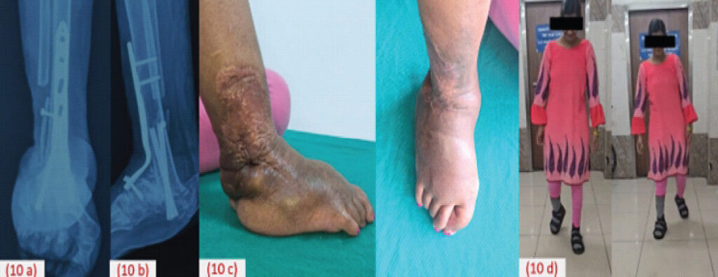 Figure 10: 1-year follow-up showing anteroposterior (a) and lateral view (b) radiographs with clinical image (c) and patient ambulation (d).