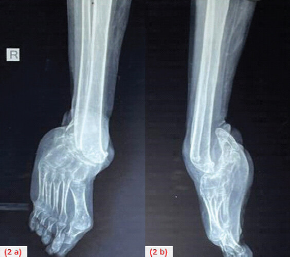 Figure 2: Radiograph of ankle joint anteroposterior view (a) and lateral view (b).