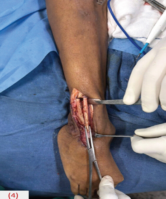 Figure 4: Surgical step showing transfibular approach after distal fibular osteotomy.