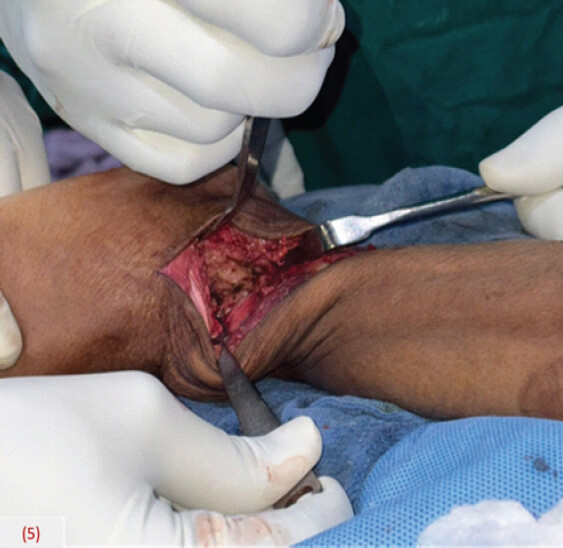 Figure 5: Preparation of tibiocalcaneal arthrodesis site.