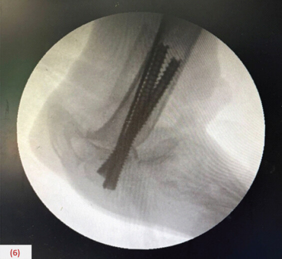 Figure 6: C-arm images showing tibiocalcaneal arthrodesis using beam screws.