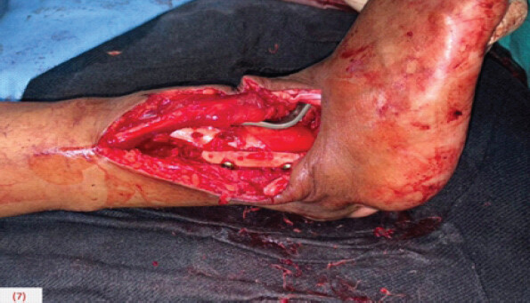 Figure 7: Intraoperative picture after anterior fusion plate fixation and repositioned lateral malleolus.