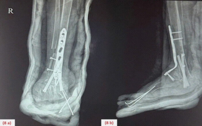 Figure 8: Post-operative radiograph showing anteroposterior (a) and lateral (b) views.