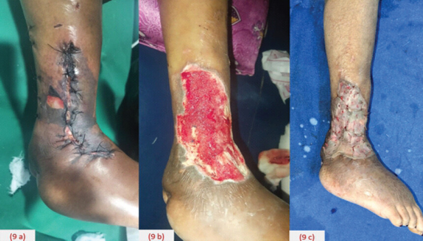 Figure 9: Post-operative skin necrosis on day 5 (a), which subsequently underwent debridement and Vacuum assisted closure (b) and Split Thickness skin grafting (c).