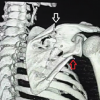 Fixation of Displaced Lateral Column and Spine of Scapula using Modified Judet Approach