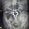 Navigating Post-operative Complications: A Case Report of Cerebrospinal Fluid Leak and Pan-Resistant Enterobacter Infection Following Lumbar Fusion
