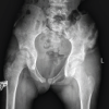 Methicillin-Resistant Staphylococcus aureus Iliac Osteomyelitis with Cortical Breach Mimicking Septic Arthritis of the Hip in a Child: A Diagnostic Pitfall