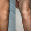 Recurrence of a Benign Tumor: The Challenge of a Knee Intra-articular Schwannoma – A Case Report