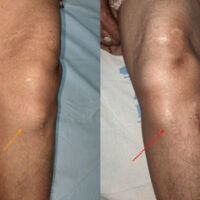 Figure 1: Pre-operative clinical picture of the swelling. Clinical picture showing the (a) Site of the swelling and (b) Scar marks from the previous surgery.