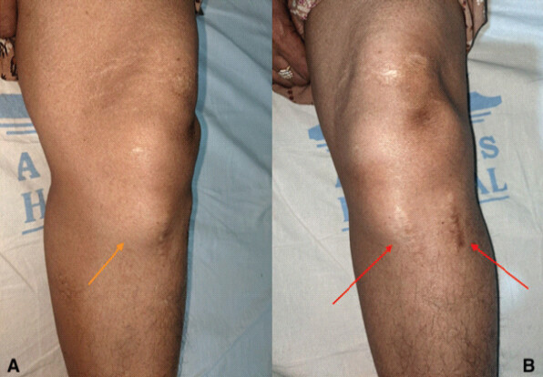 Figure 1: Pre-operative clinical picture of the swelling. Clinical picture showing the (a) Site of the swelling and (b) Scar marks from the previous surgery.