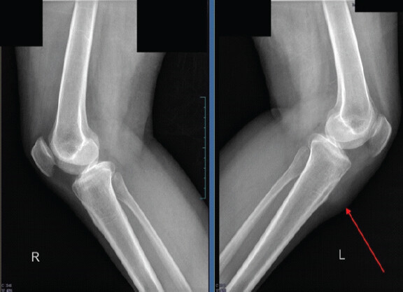 Figure 2: Pre-operative X-rays of the bilateral knee in lateral view. X-rays of the bilateral knees in lateral view showing soft tissue shadow (red arrow) on the left side.