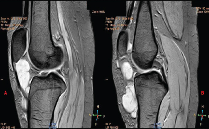 Figure 3: Magnetic resonance imaging of the knee (sagittal) showing the lesion. A T2-weighted proton density fat-saturated image of the left knee reveals a distinct, well-circumscribed juxta-articular multilobulated lesion within the infrapatellar fat pad, measuring approximately 6.7 × 5.5 × 2.5 cm (a), extending inferiorly to the pretibial fat (b).