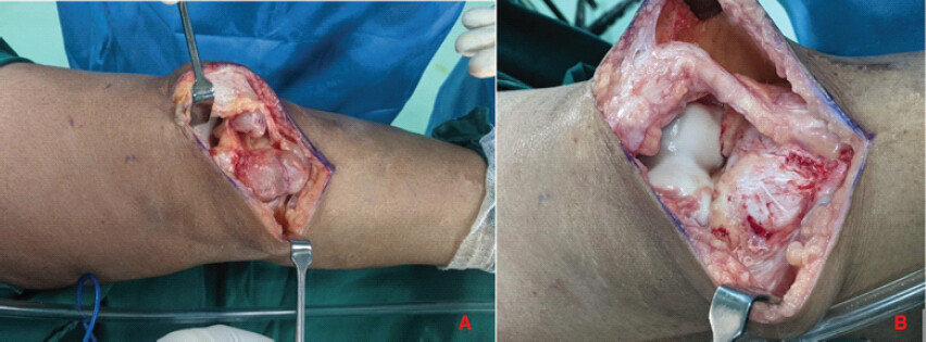 Figure 4: Intra-operative image showing the lesion before and after the excision. Intra-operative images showing a multilobulated encapsulated lesion in the Hoffa’s fat pad region (a) and an image following excision of the tumor (b).