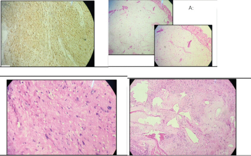 Figure 5: Histopathological image of the excised lesion. A photomicrograph stained with Hematoxylin and Eosin (H&E) shows a cellular spindle cell lesion with varying degrees of cell density (a). The spindle cells demonstrated eosinophilic fibrillary cytoplasm and elongated ovoid nuclei, arranged in intersecting fascicles and whorls (magnification, ×200). Immunohistochemical staining revealed that the tumor cells were strongly positive for S-100 protein (b) (magnification, ×200).