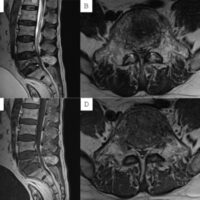 Figure 1: Sagittal and axial magnetic resonance imaging (MRI) showing L5 pathological fracture with thecal sac compression on T2-weighted MRI (a and b) and T1-weighted MRI (c and d).