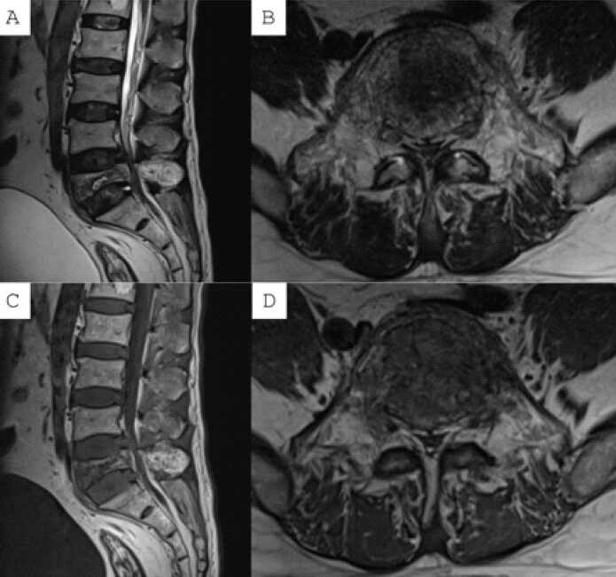 Figure 1: Sagittal and axial magnetic resonance imaging (MRI) showing L5 pathological fracture with thecal sac compression on T2-weighted MRI (a and b) and T1-weighted MRI (c and d).