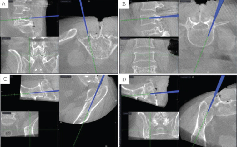 Figure 2: O-arm navigation-guided identification of left L5 pedicle for stentoplasty (a), L4 right pedicle screw trajectory (b), S2-alar-iliac screw (c and d).
