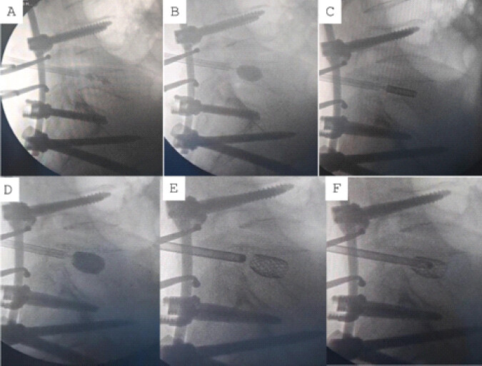 Figure 3: Fluoroscopy-guided stentoplasty technique showing insertion of stentoplasty balloon through a transpedicular cannula (a), inflation of stentoplasty balloon (b), introducing stent (c), expansion of stent with the help of stentoplasty balloon (d), fully deployed stent (e), inserting stentoplasty cement via cannula (f).