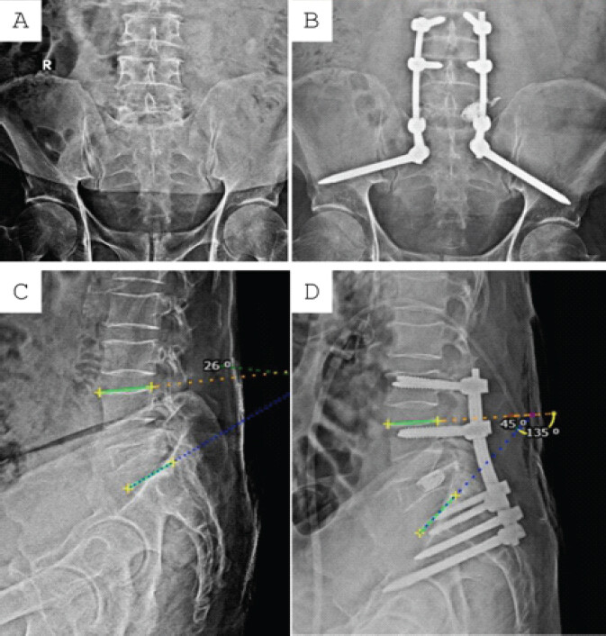 Figure 4: Comparison of pre-operative and 12th-month post-operative) Antero-posterior radiograph of lumbo-sacral spine showing instrumentation from L3 to S2-alar-iliac level with left-sided L5 stent (a and b), pre-operative and post-operative lateral radiograph showing improvement in local Cobb’s angle from 26° to 45° (c and d).