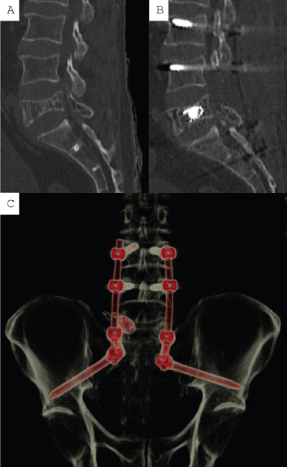 Figure 5: Comparison of pre-operative and 1-year post-operative computed tomography (CT) scan showing maintained vertebral height (a and b), 3-D CT reconstruction showing complete spino-pelvic instrumentation and stent (c).