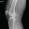 Ultrasound and Fluoroscopy-Guided Percutaneous Hydrotenotomy with Open Conversion for Symptomatic Periligamentous Calcification of the Medial Collateral Ligament: A Case Report